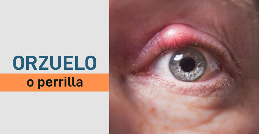 Orzuelo o perrilla